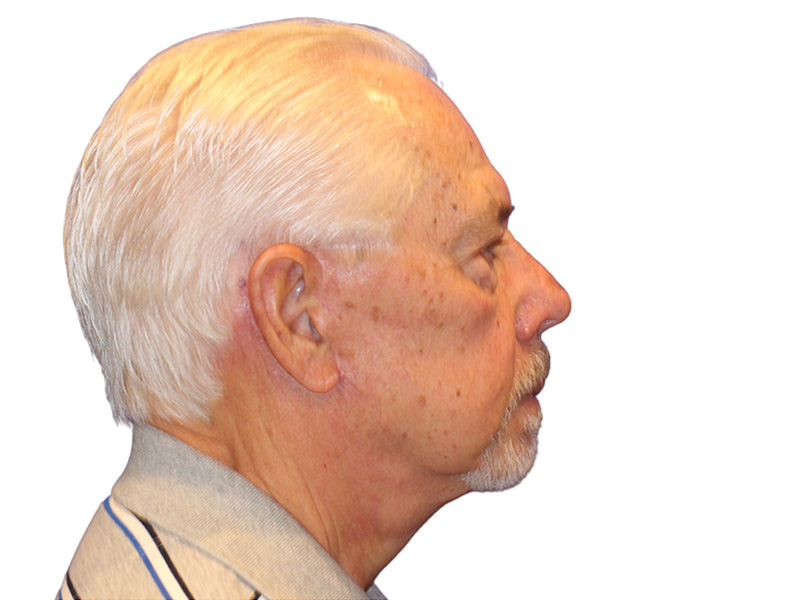 Facelift Before and After | PERK Plastic Surgery