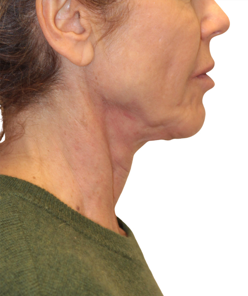 Facelift Before and After | PERK Plastic Surgery