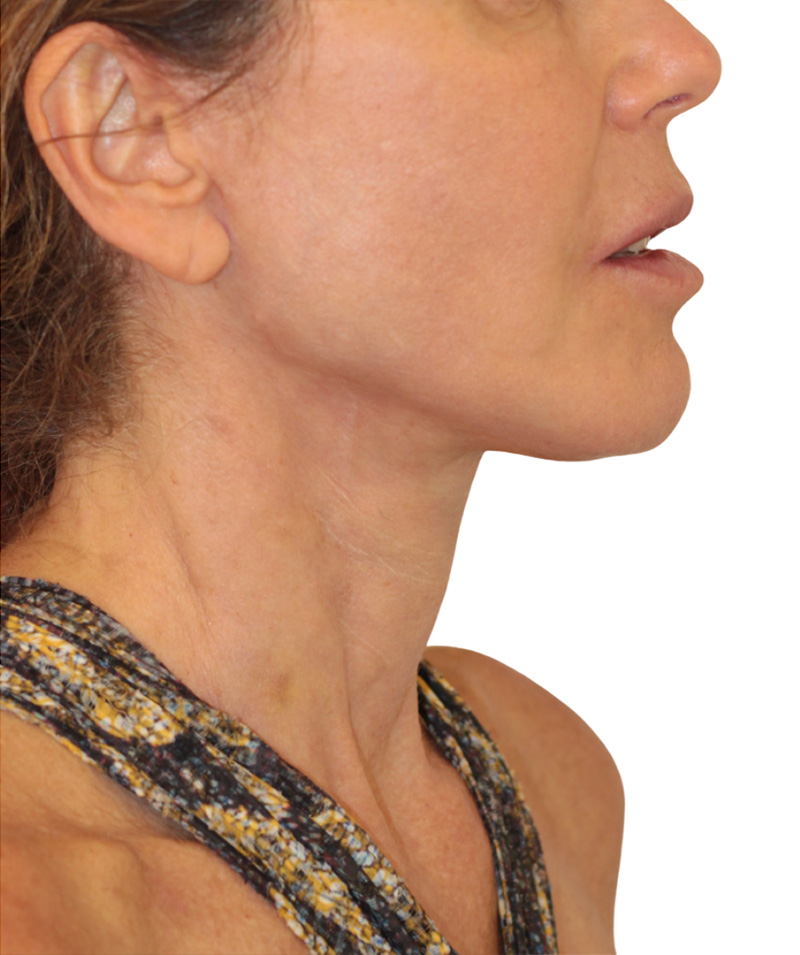 Facelift Before and After | PERK Plastic Surgery