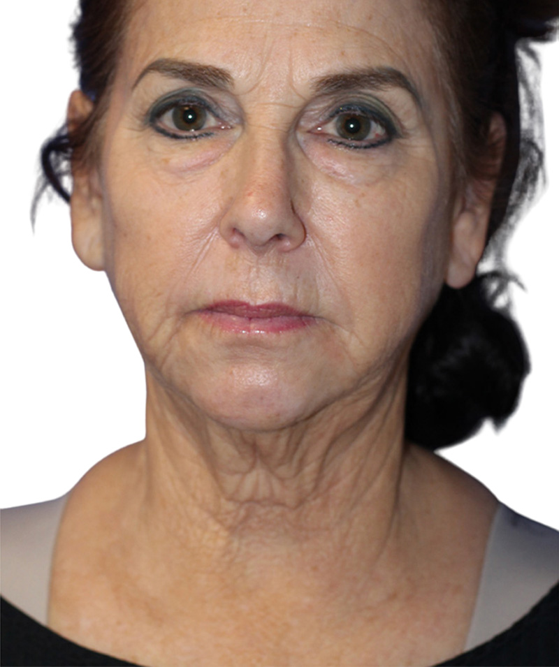 Facelift Before and After | PERK Plastic Surgery