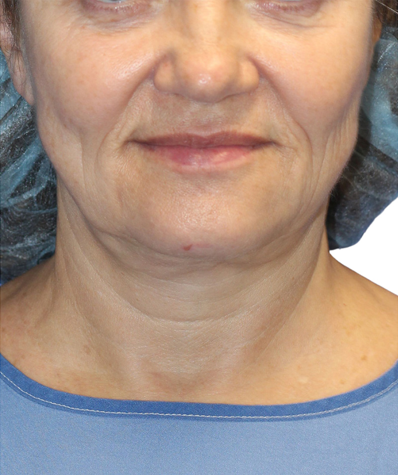 Facelift Before and After | PERK Plastic Surgery