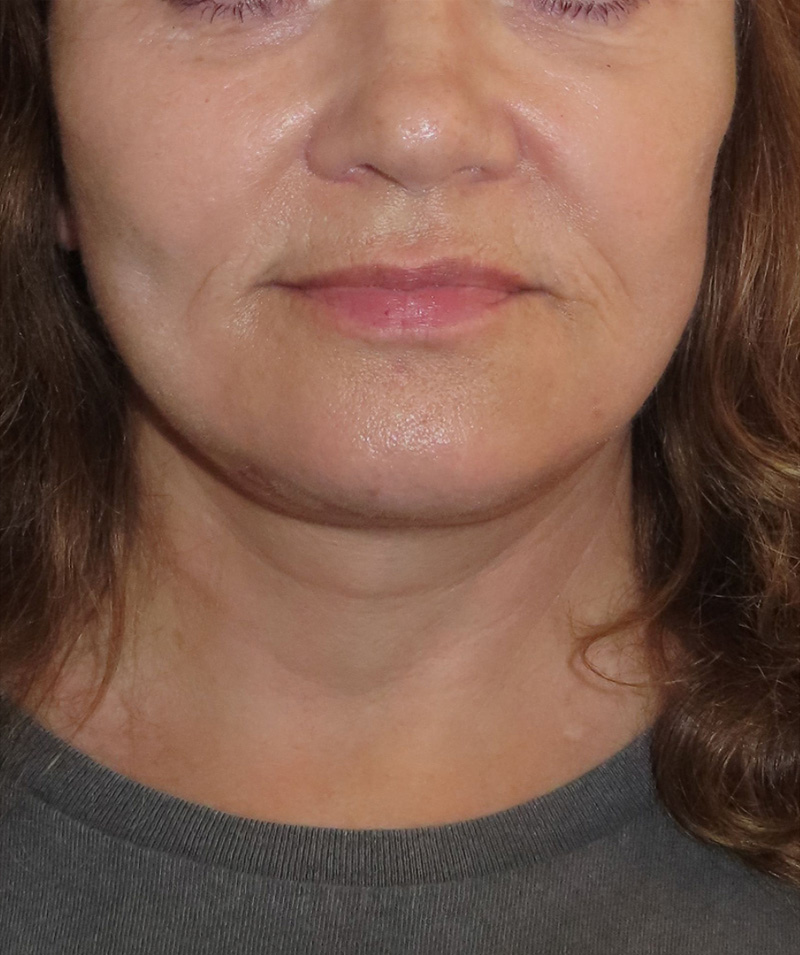 Facelift Before and After | PERK Plastic Surgery