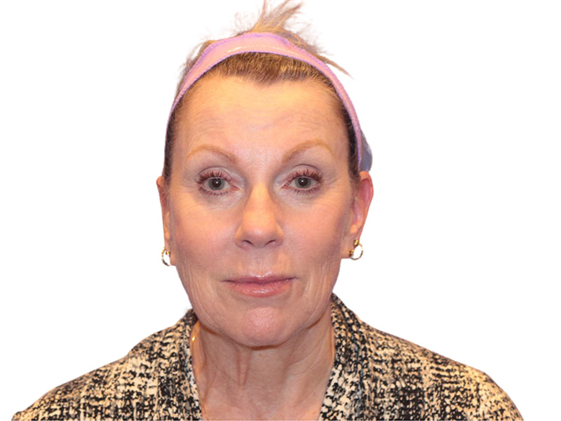 Facelift Before and After | PERK Plastic Surgery