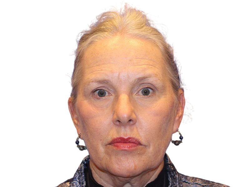 Facelift Before and After | PERK Plastic Surgery