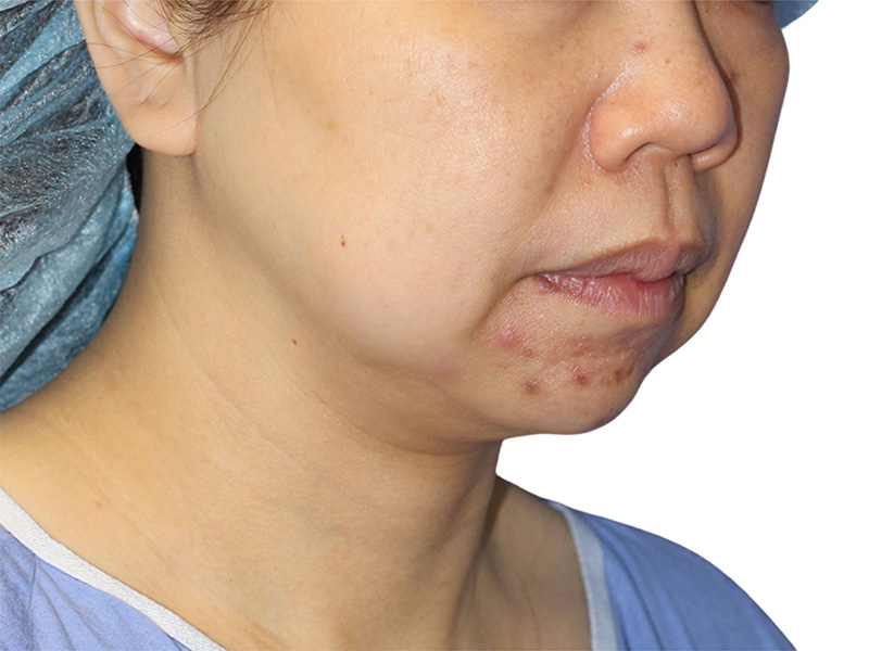 Facelift Before and After | PERK Plastic Surgery