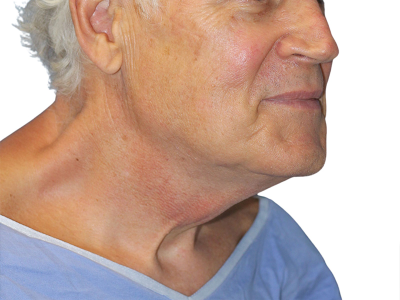Facelift Before and After | PERK Plastic Surgery