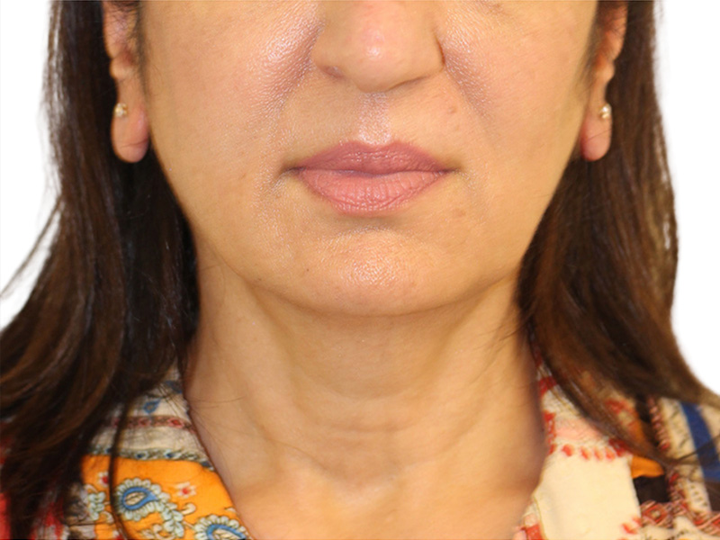 Facelift Before and After | PERK Plastic Surgery