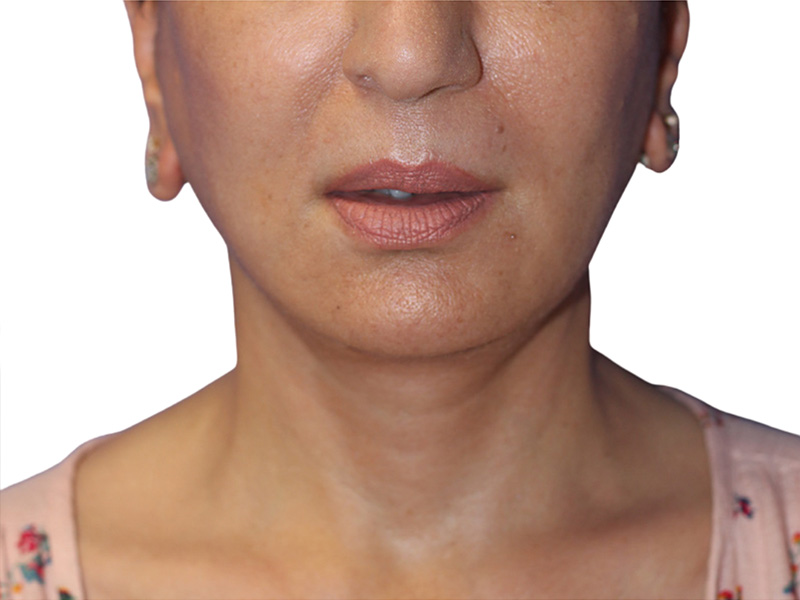 Facelift Before and After | PERK Plastic Surgery