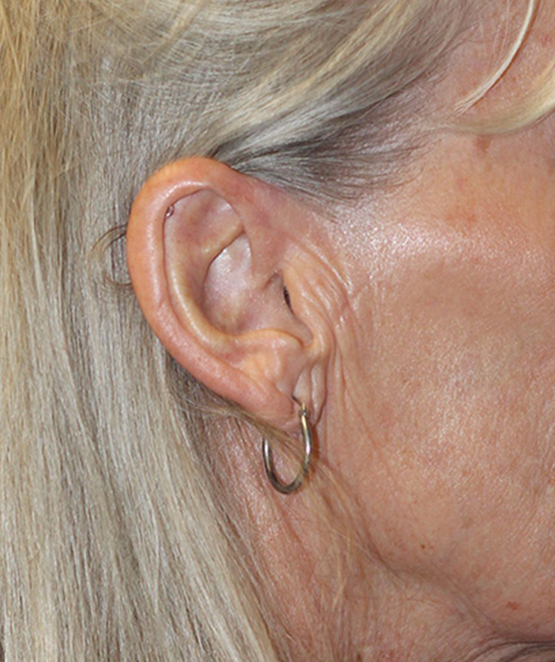 Facelift Before and After | PERK Plastic Surgery