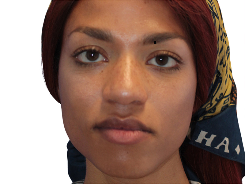 Facial Feminization Before and After | PERK Plastic Surgery
