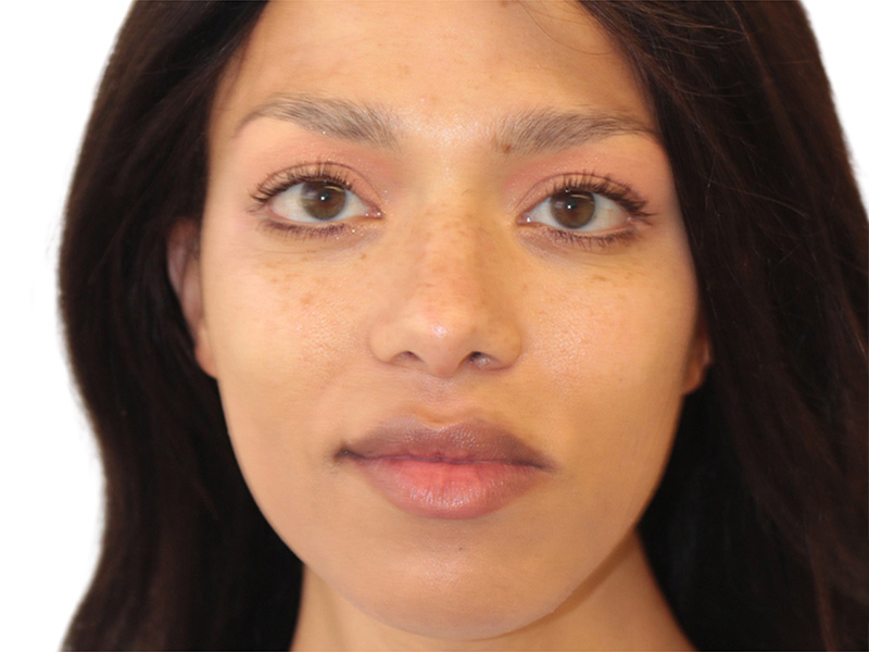 Facial Feminization Before and After | PERK Plastic Surgery