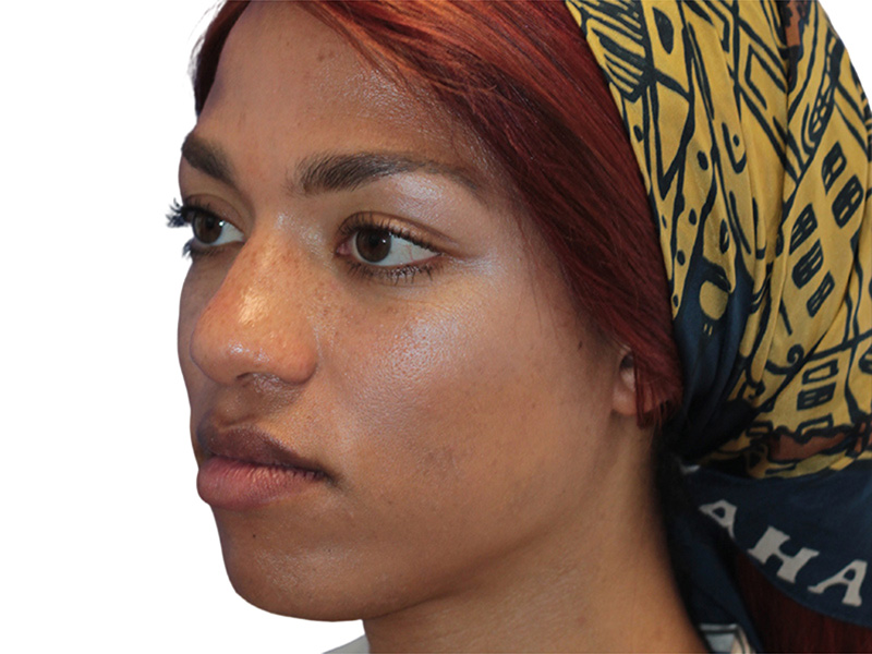 Facial Feminization Before and After | PERK Plastic Surgery