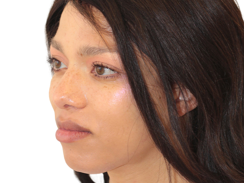 Facial Feminization Before and After | PERK Plastic Surgery