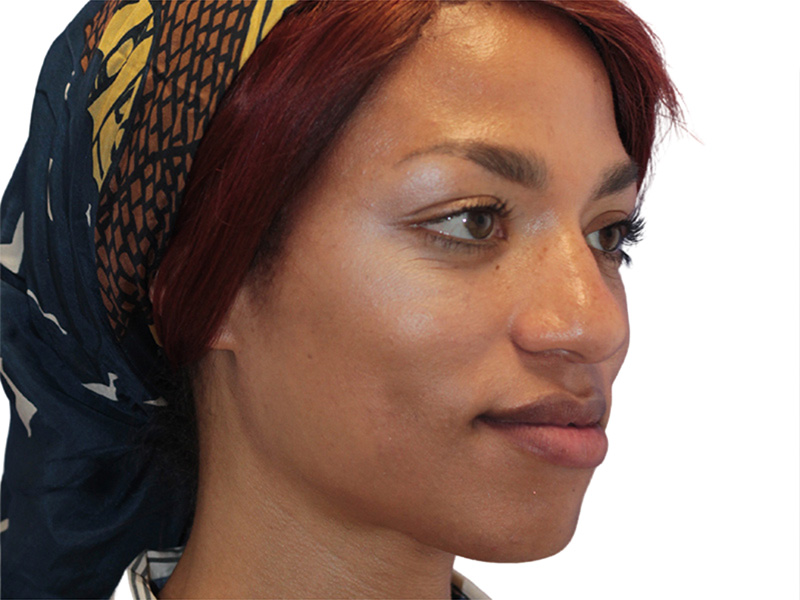 Facial Feminization Before and After | PERK Plastic Surgery