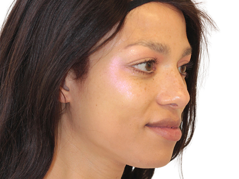 Facial Feminization Before and After | PERK Plastic Surgery