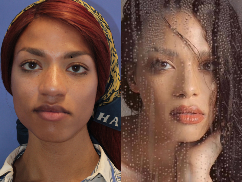 Facial Feminization Before and After | PERK Plastic Surgery