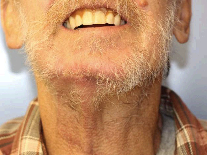 Facial Reconstruction Before and After | PERK Plastic Surgery