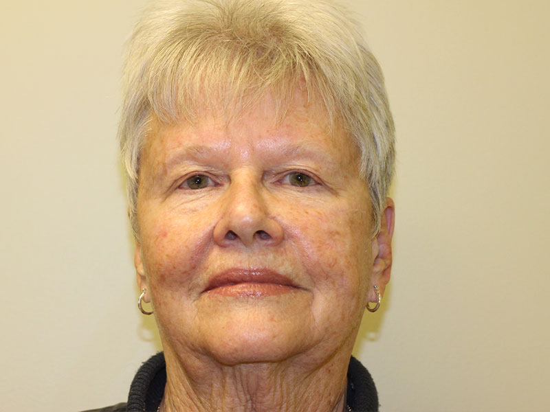 Facial Reconstruction Before and After | PERK Plastic Surgery