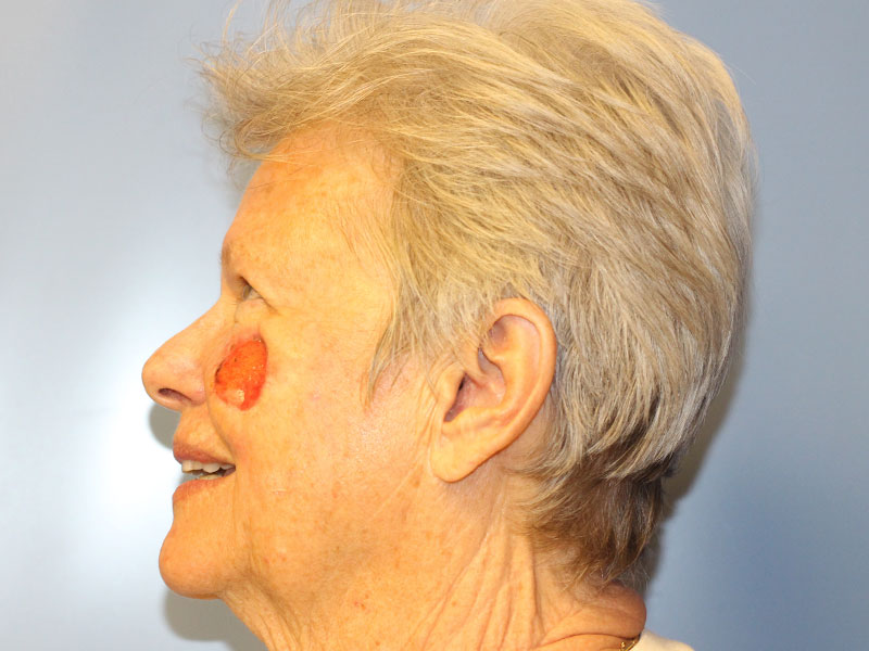 Facial Reconstruction Before and After | PERK Plastic Surgery