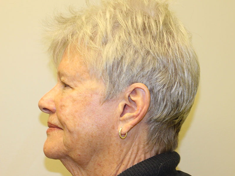 Facial Reconstruction Before and After | PERK Plastic Surgery
