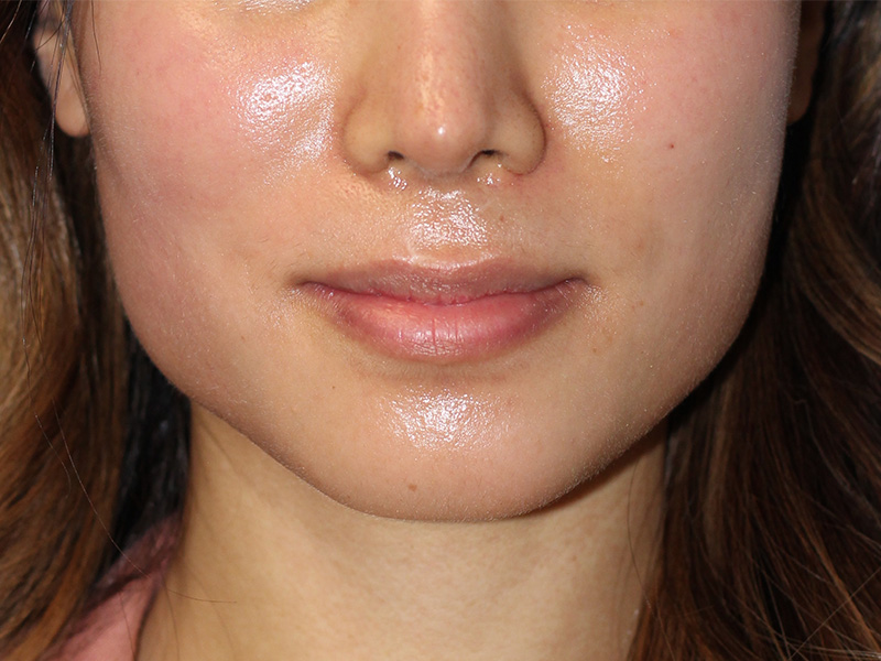 Lip Lift Before and After | PERK Plastic Surgery