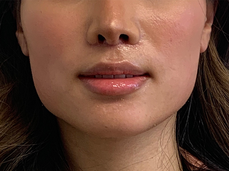 Lip Lift Before and After | PERK Plastic Surgery