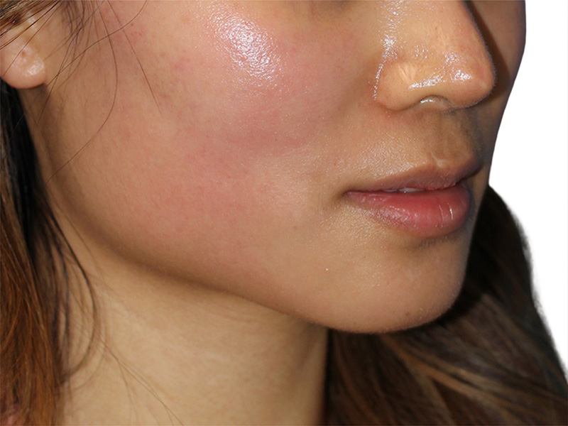 Lip Lift Before and After | PERK Plastic Surgery