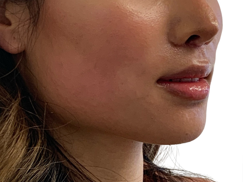 Lip Lift Before and After | PERK Plastic Surgery