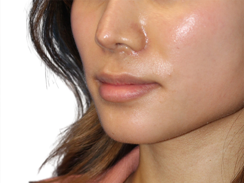 Lip Lift Before and After | PERK Plastic Surgery
