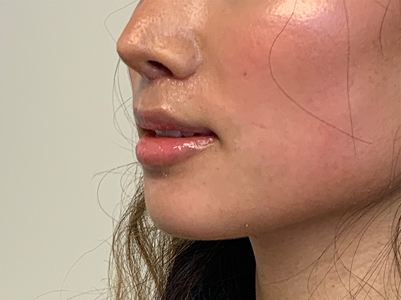 Lip Lift Before and After | PERK Plastic Surgery