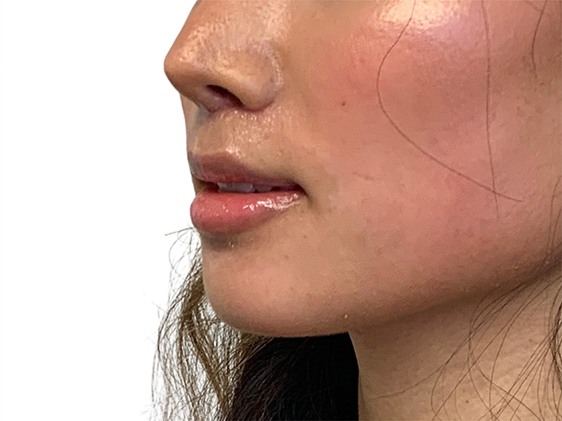 Lip Lift Before and After | PERK Plastic Surgery