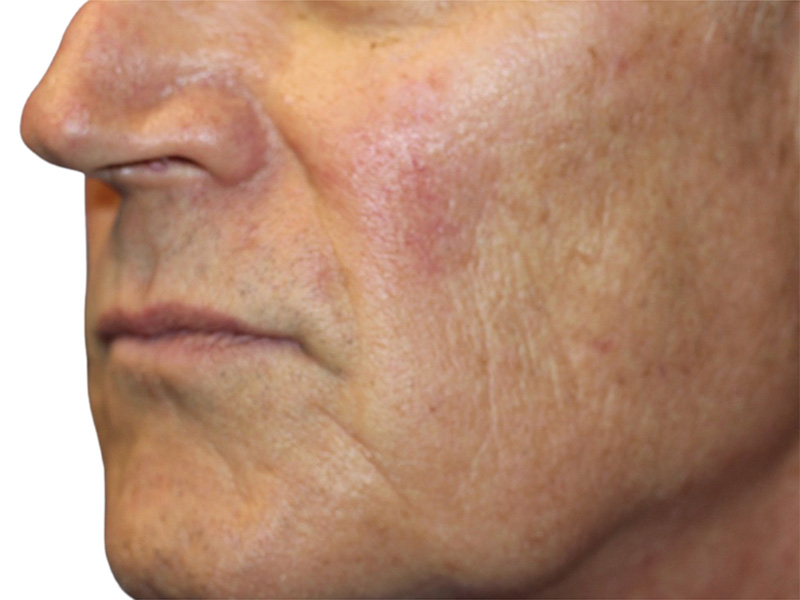 Lip Lift Before and After | PERK Plastic Surgery