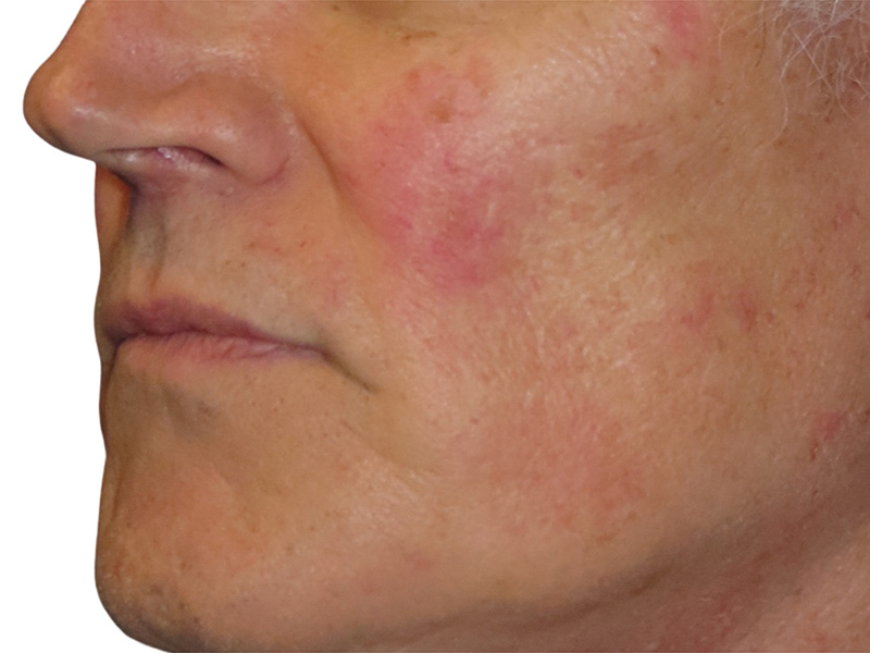 Lip Lift Before and After | PERK Plastic Surgery