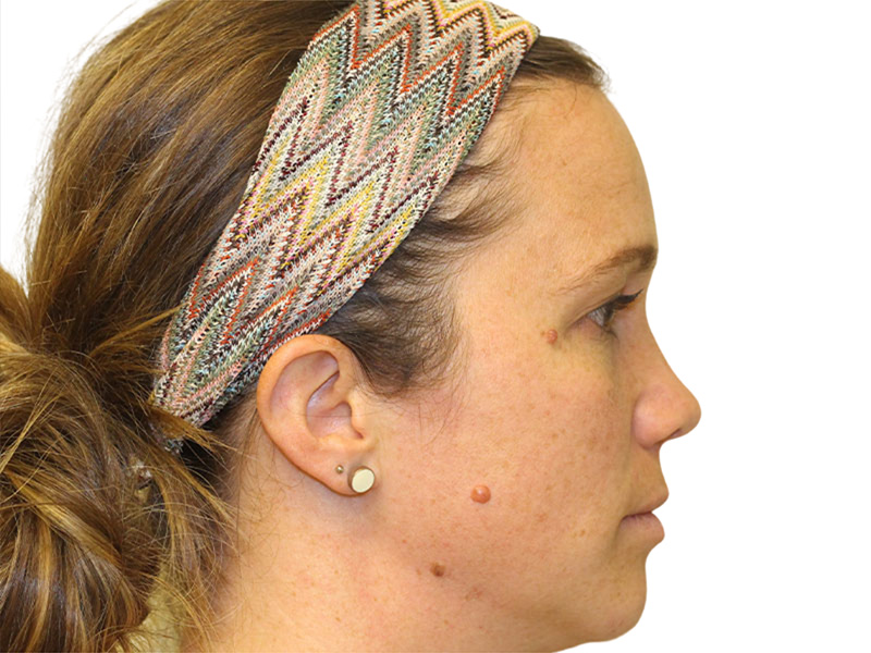 Moles And Cysts Before and After | PERK Plastic Surgery