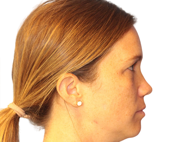 Moles And Cysts Before and After | PERK Plastic Surgery