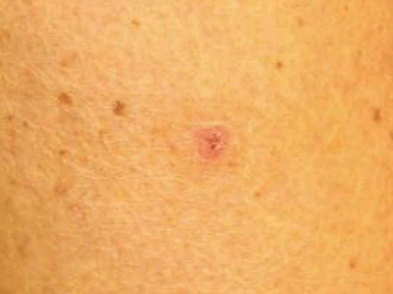 Moles And Cysts Before and After | PERK Plastic Surgery