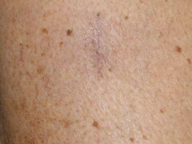 Moles And Cysts Before and After | PERK Plastic Surgery
