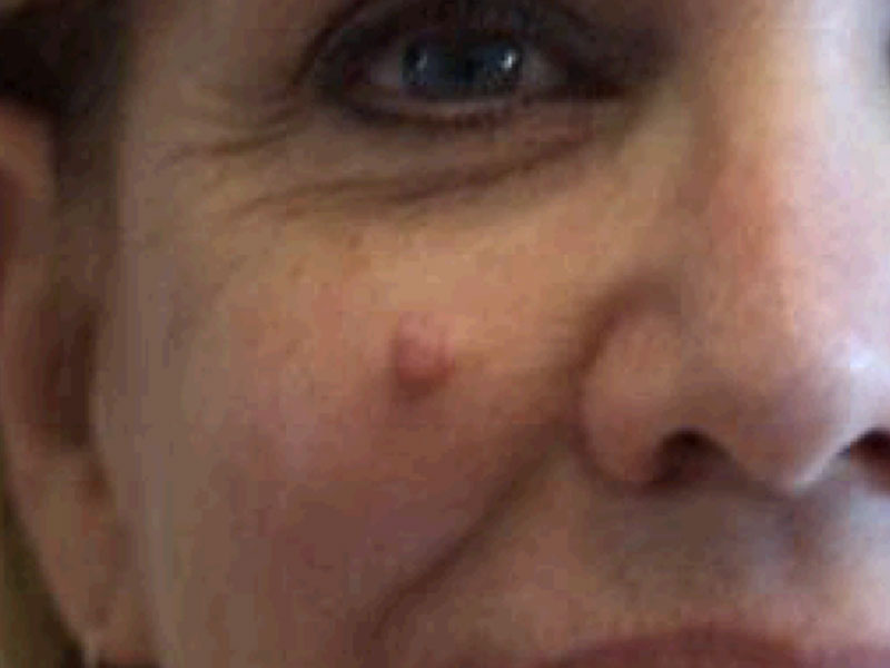 Moles And Cysts Before and After | PERK Plastic Surgery