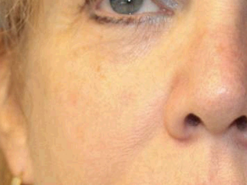 Moles And Cysts Before and After | PERK Plastic Surgery