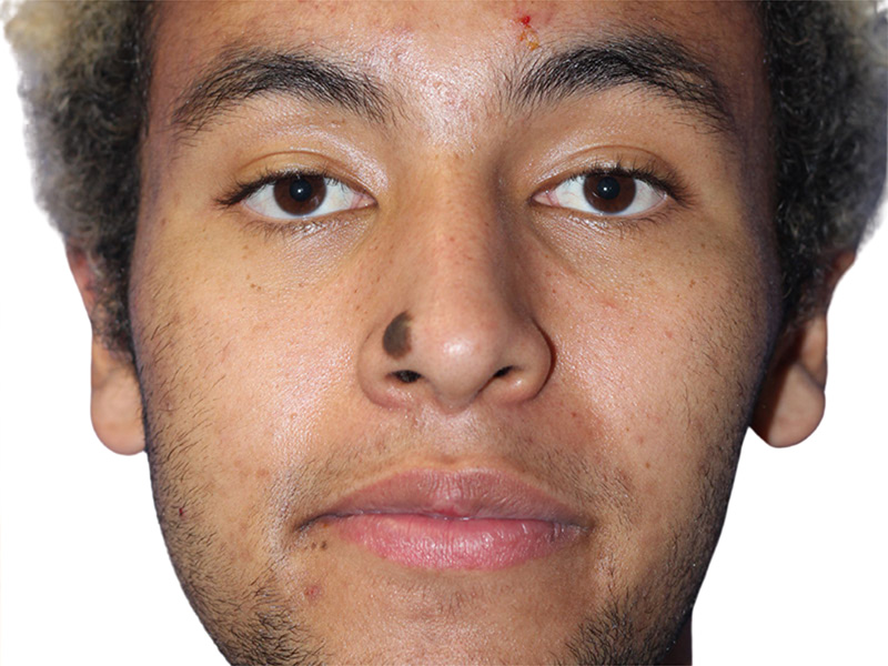 Moles And Cysts Before and After | PERK Plastic Surgery