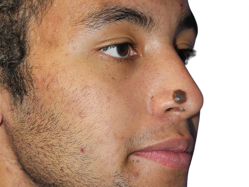 Moles And Cysts Before and After | PERK Plastic Surgery