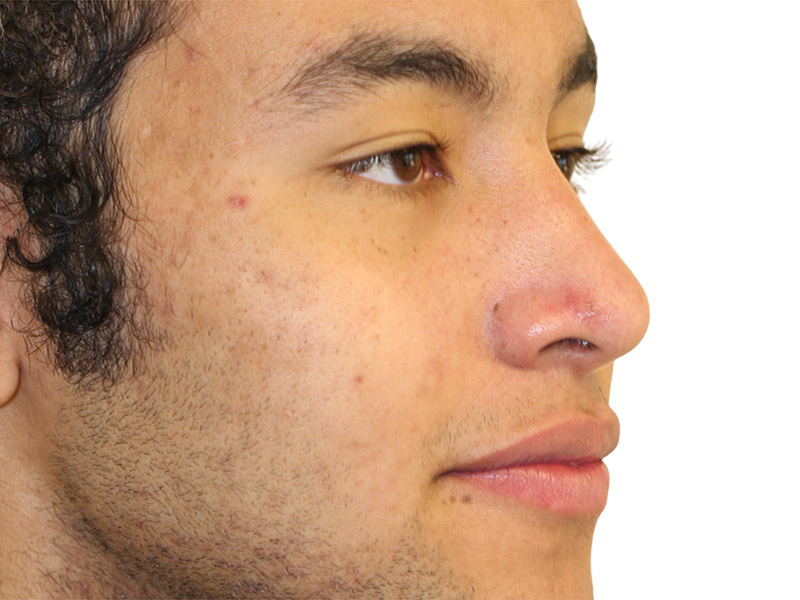 Moles And Cysts Before and After | PERK Plastic Surgery