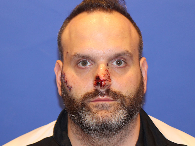 Nasal Reconstruction Before and After | PERK Plastic Surgery