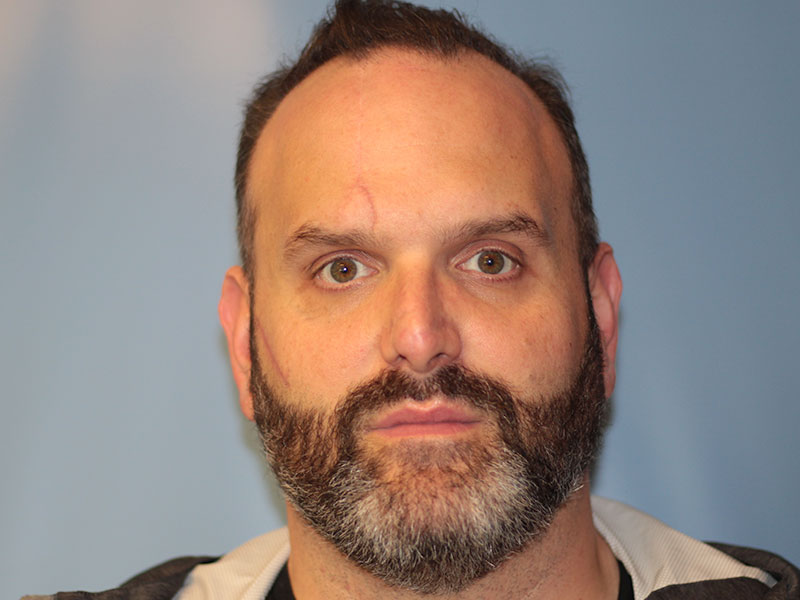 Nasal Reconstruction Before and After | PERK Plastic Surgery