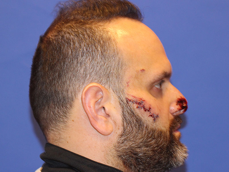 Nasal Reconstruction Before and After | PERK Plastic Surgery