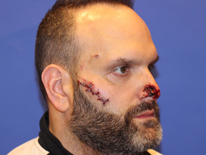Nasal Reconstruction Before and After | PERK Plastic Surgery