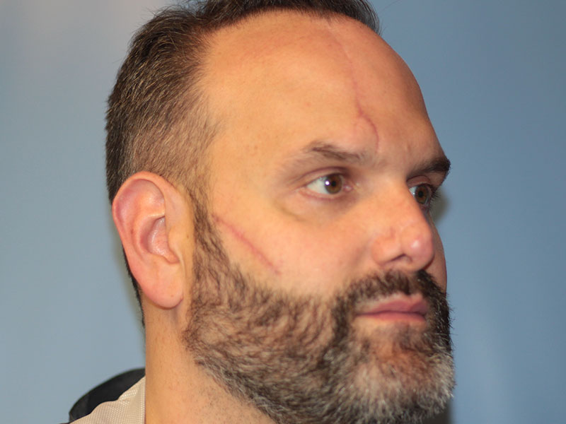 Nasal Reconstruction Before and After | PERK Plastic Surgery