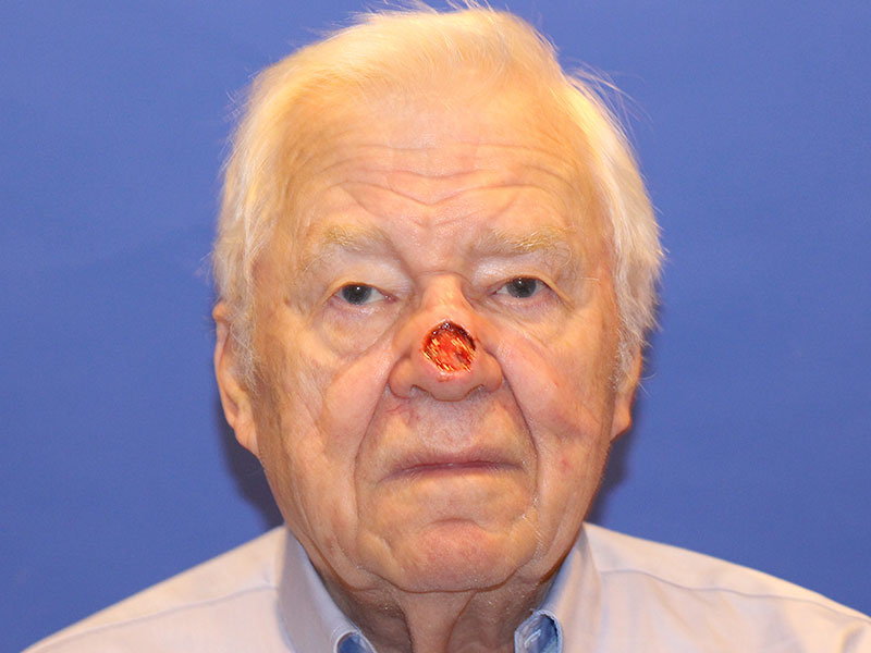 Nasal Reconstruction Before and After | PERK Plastic Surgery