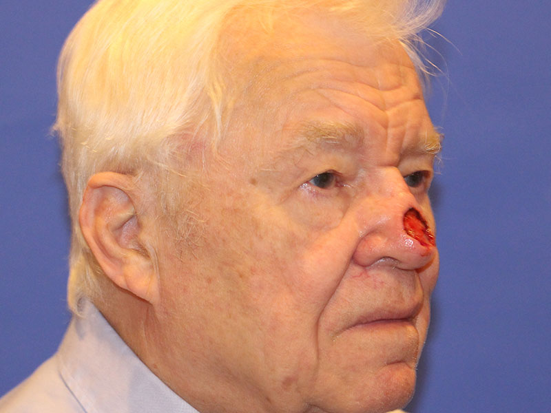 Nasal Reconstruction Before and After | PERK Plastic Surgery