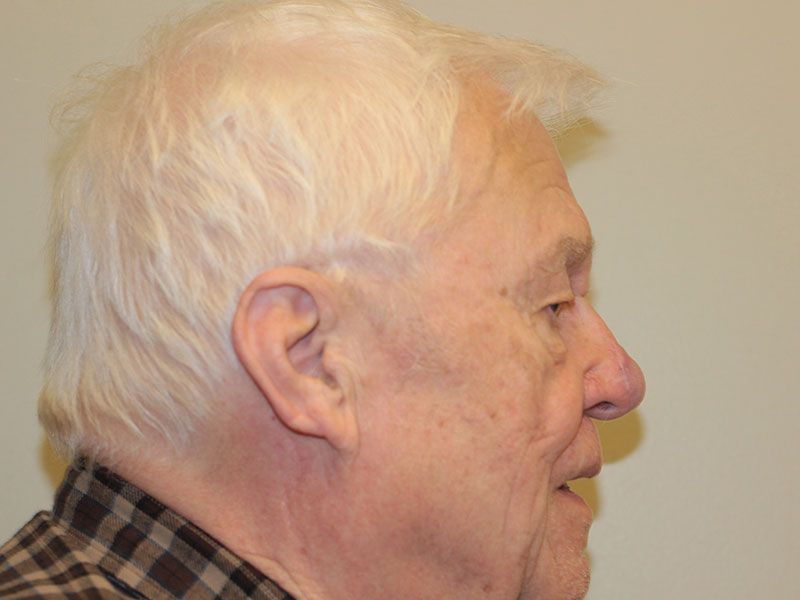 Nasal Reconstruction Before and After | PERK Plastic Surgery